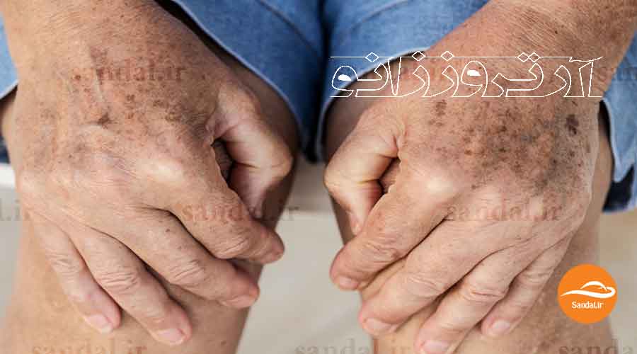 درمان و علت آرتروز زانو