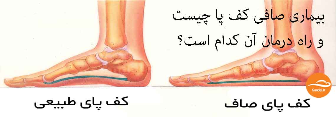 بیماری کف پای صاف چیست